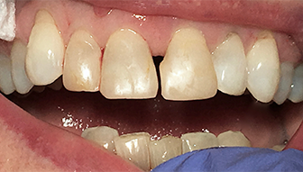 Cracked and broken teeth before dental treatment